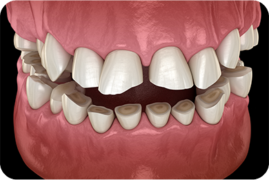 診療案内14_歯ぎしり・食いしばり