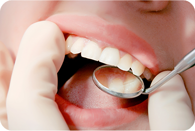 診療案内05_むし歯