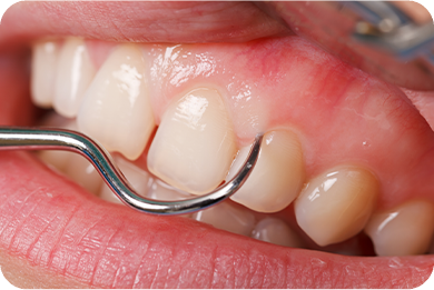 診療案内02_歯周病