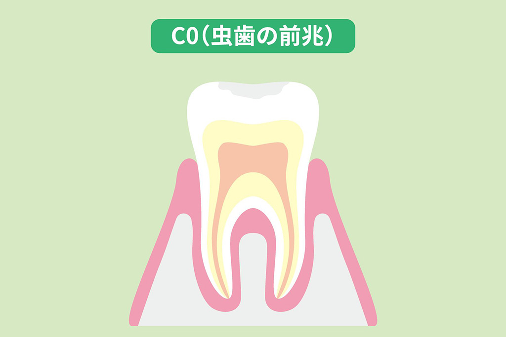 初期むし歯(CO)