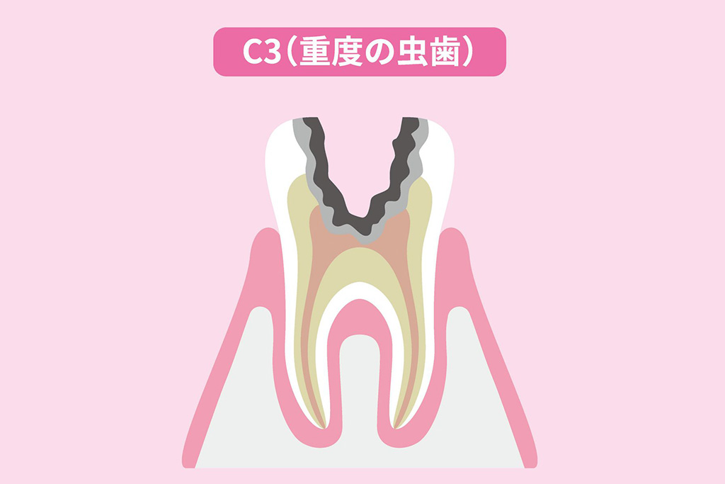 神経まで達したむし歯(C3)