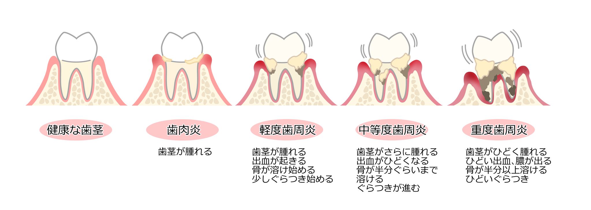歯周病の進行と症状